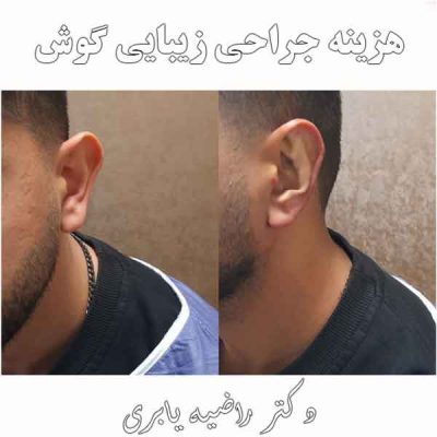 هزینه جراحی زیبایی گوش