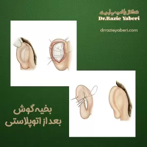 بخیه گوش بعد از اتوپلاستی https://drrazieyaberi.com/
