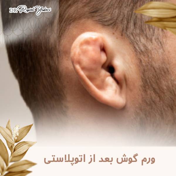 ورم گوش بعد از اتوپلاستی