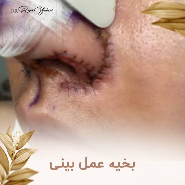 بخیه عمل بینی