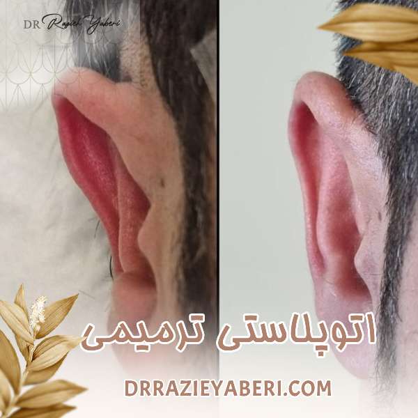 اتوپلاستی ترمیمی