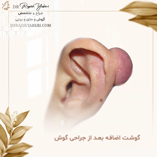 گوشت اضافه بعد از جراحی گوش - دکتر یابری