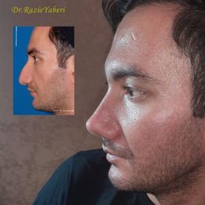 rhinoplasty-139