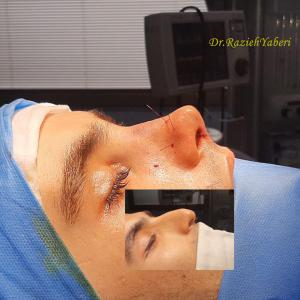 rhinoplasty-140