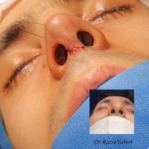 rhinoplasty-141