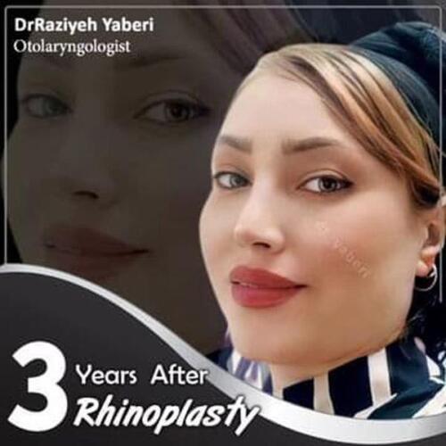 جراحی-بینی-61