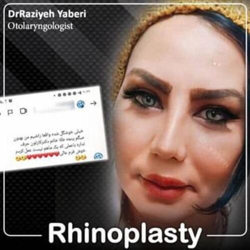 جراحی-بینی-63