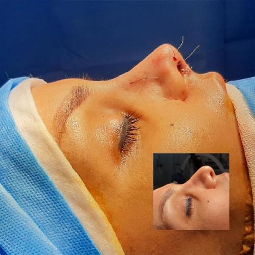 جراحی-بینی-75