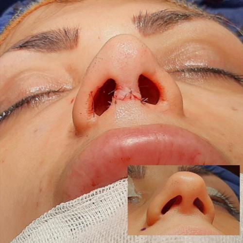 جراحی-بینی-77