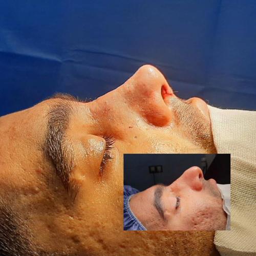 جراحی-بینی-80