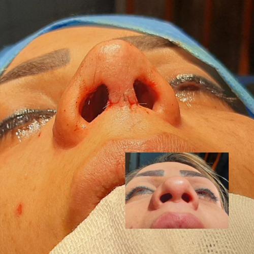 جراحی-بینی-81