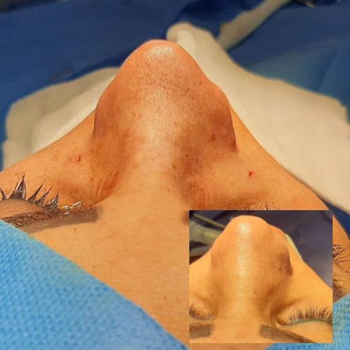 جراحی-بینی-82