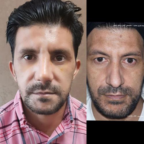 جراحی-بینی-82 (1)