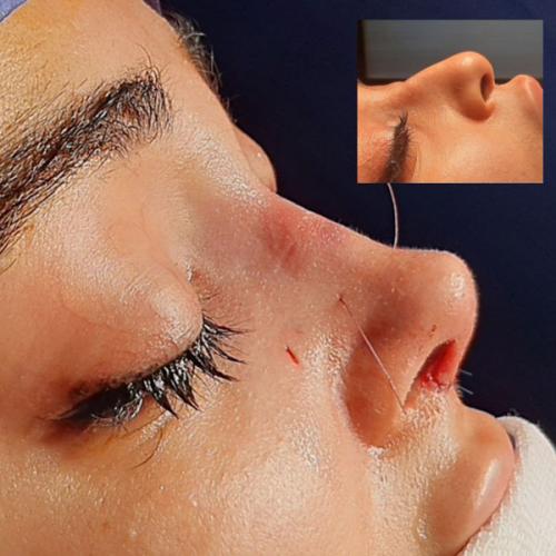 جراحی-بینی-84