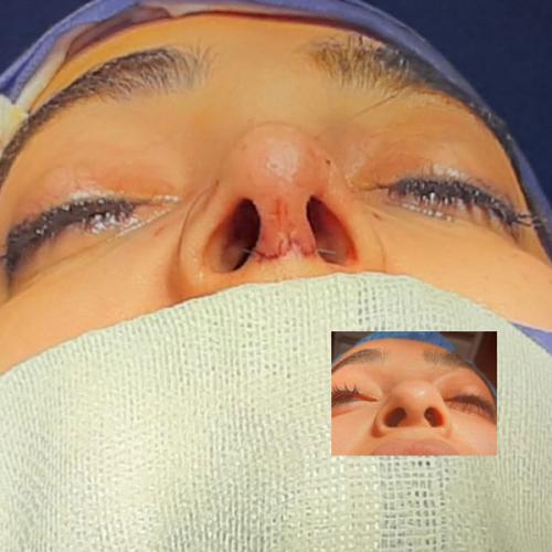 جراحی-بینی-85