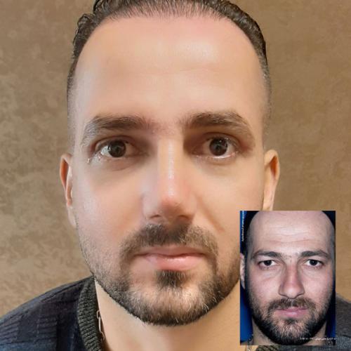 جراحی-بینی-86