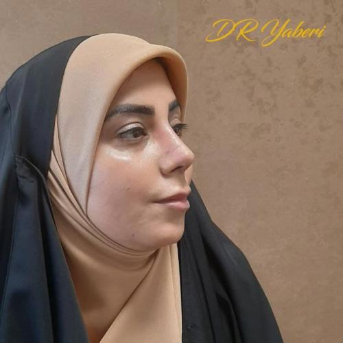 جراحی-بینی-در-تهران-100