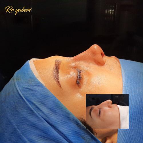 جراحی-بینی-در-تهران-109