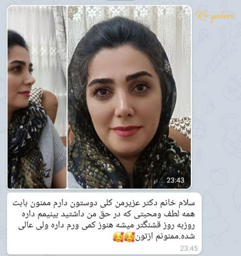 جراحی-بینی-در-تهران-110