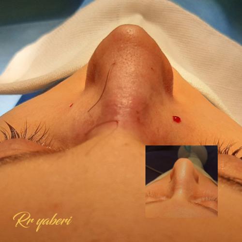 جراحی-بینی-در-تهران-112