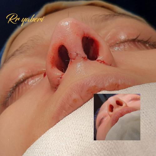 جراحی-بینی-در-تهران-113