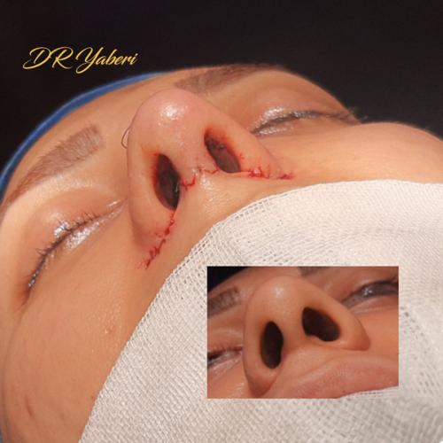 جراحی-بینی-در-تهران-115
