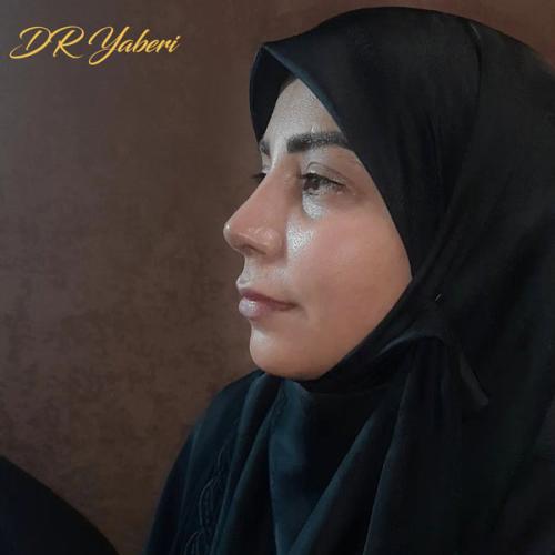 جراحی-بینی-در-تهران-117