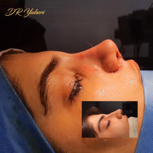 جراحی-بینی-در-تهران-118