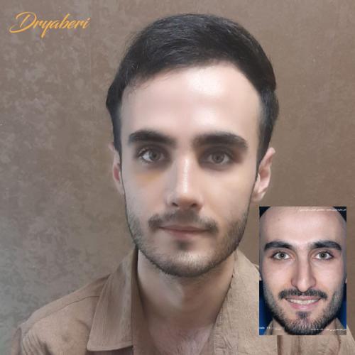 جراحی-بینی-در-تهران-133