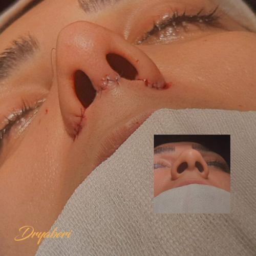 جراحی-بینی-در-تهران-134