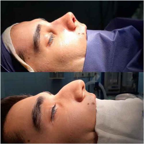 جراحی-بینی-در-تهران-136