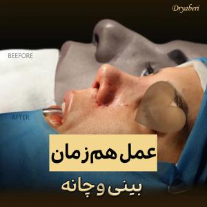 جراحی-بینی-در-تهران-137