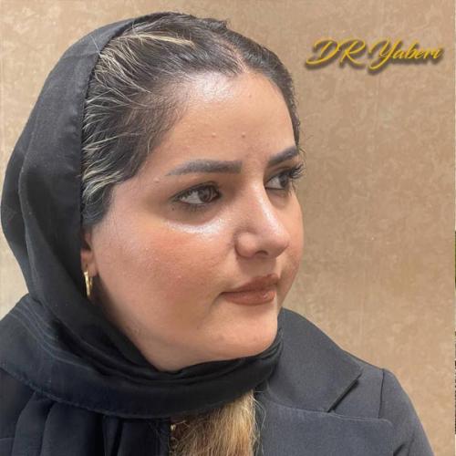 جراحی-بینی-در-تهران105