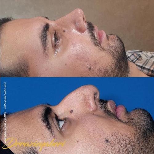 جراحی-بینی-در-تهران119