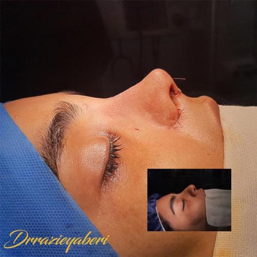 جراحی-بینی-در-تهران120