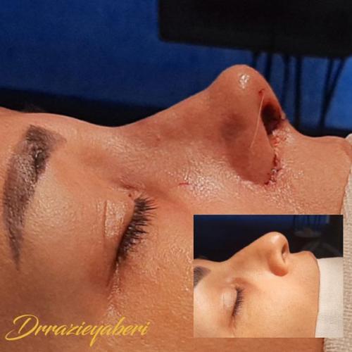 جراحی-بینی-در-تهران125