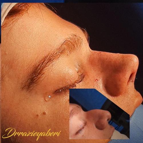 جراحی-بینی-در-تهران126