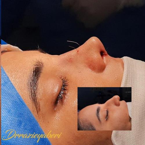 جراحی-بینی-در-تهران127