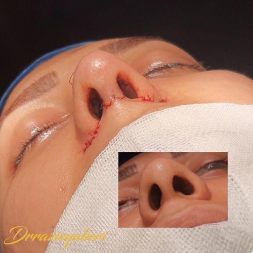 جراحی-بینی-در-تهران129