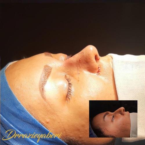 جراحی-بینی-در-تهران130