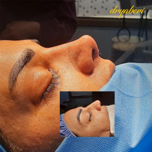 جراحی-بینی-در-تهران135