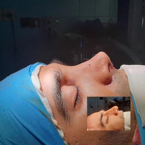 جراحی-بینی-در-تهران90