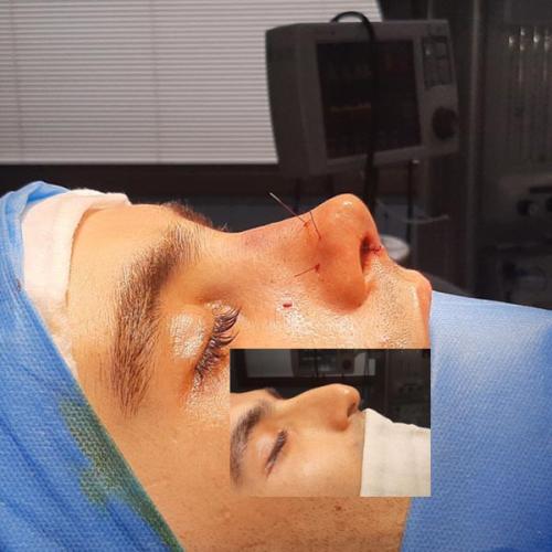 جراحی-بینی-در-تهران92