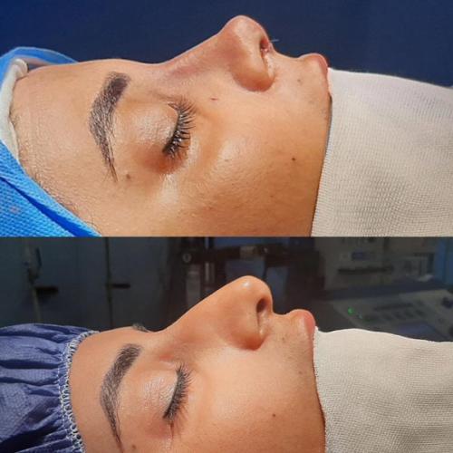 جراحی-بینی-در-تهران94