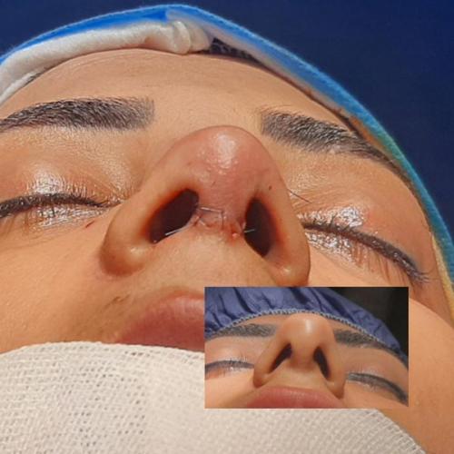 جراحی-بینی-در-تهران95