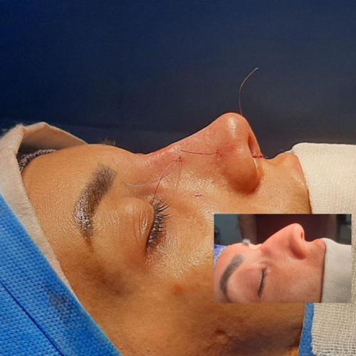 جراحی-بینی-در-تهران98