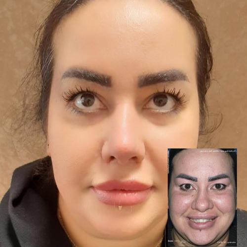 جراحی-بینی-در-تهران99