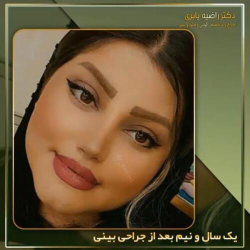 جراحی-زیبایی-بینی-10