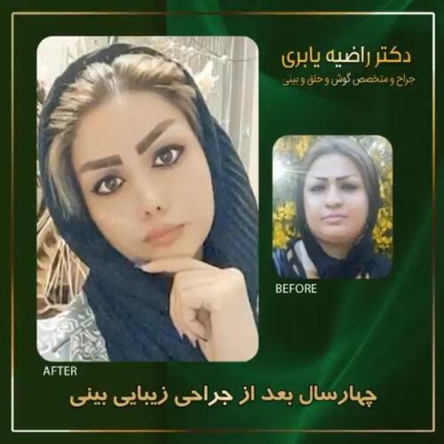 جراحی-زیبایی-بینی-11