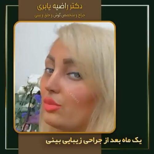 جراحی-زیبایی-بینی-13
